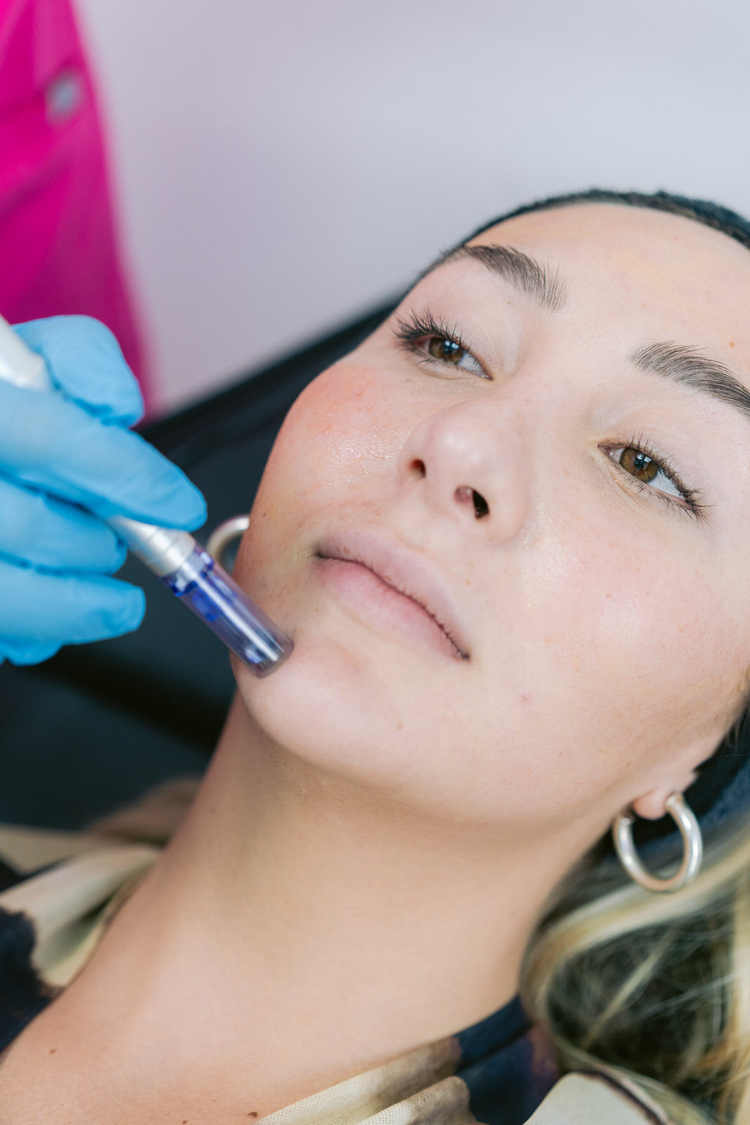 CDM Medical — Purasomes agujas mejilla primer plano
